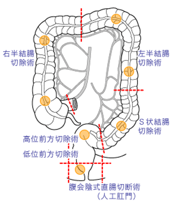 大腸がん手術の切除範囲の模式図
