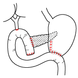 膵頭十二指腸切除術における再建