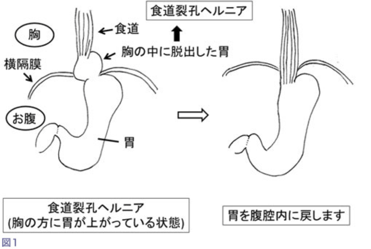 食道裂孔ヘルニア外科的治療 図1