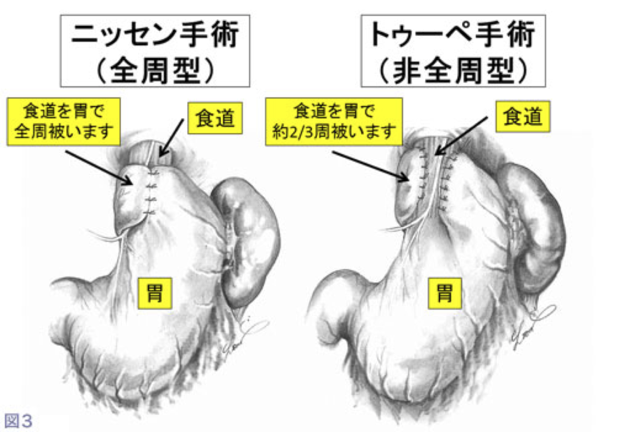 食道裂孔ヘルニア外科的治療 図3