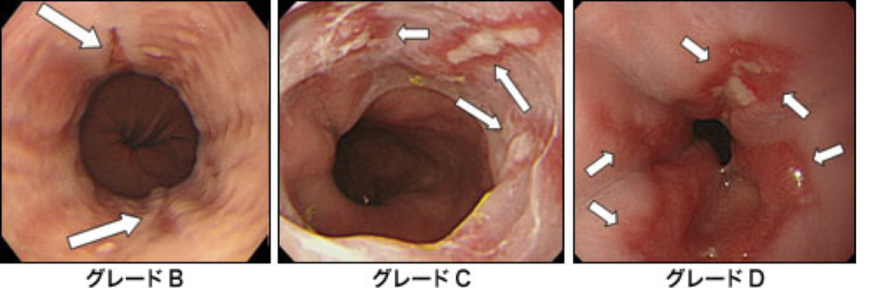 逆流性食道炎の内視鏡分類2