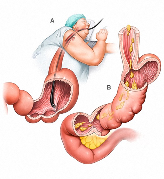内視鏡的スリーブ状胃形成術