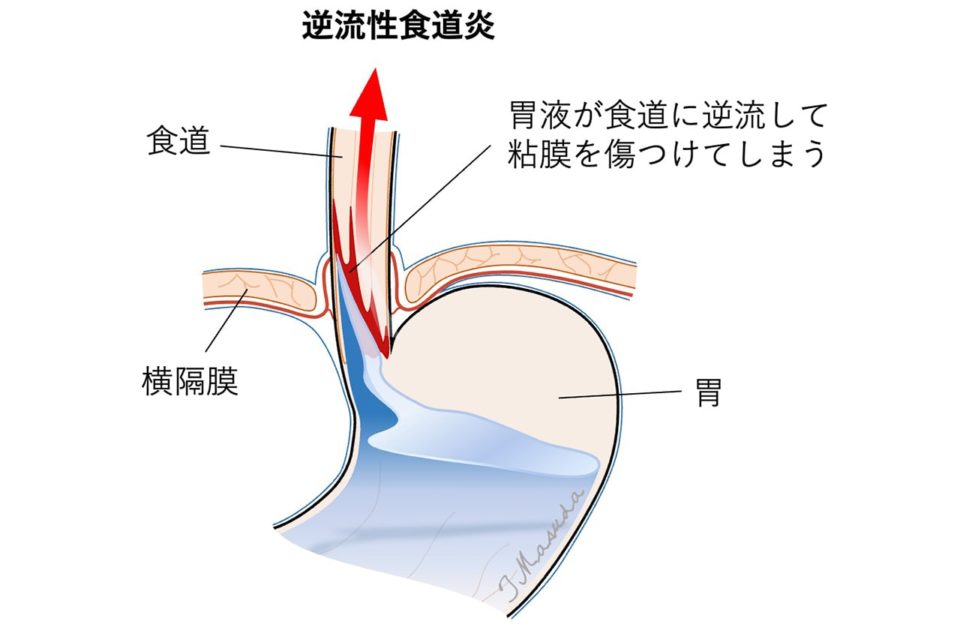 逆流性食道炎とは