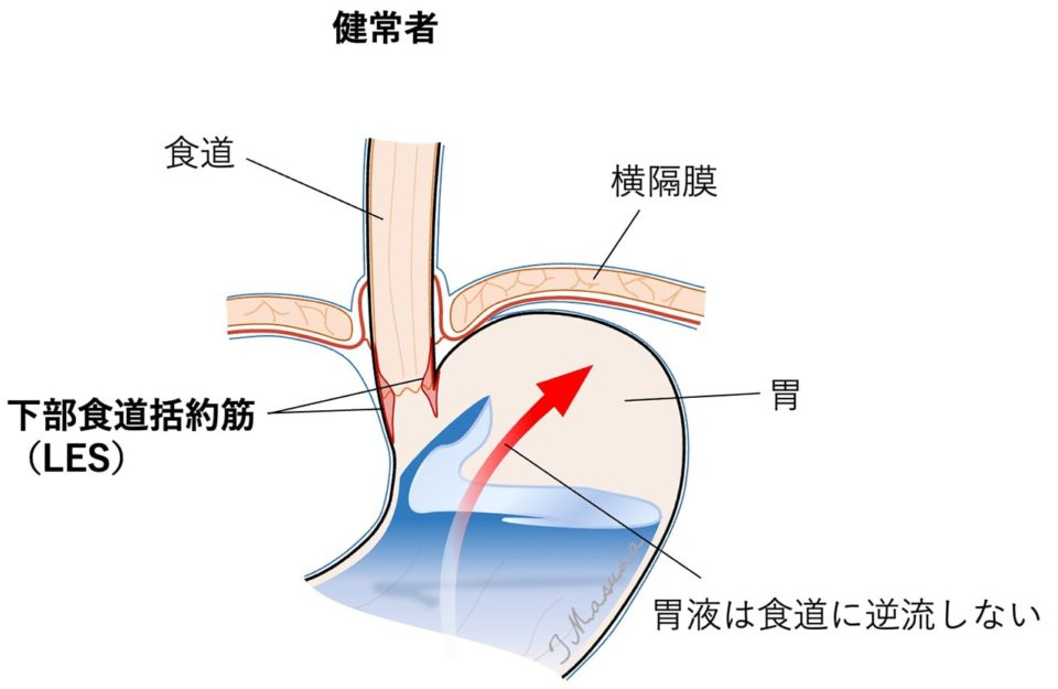 逆流性食道炎とは 健常者