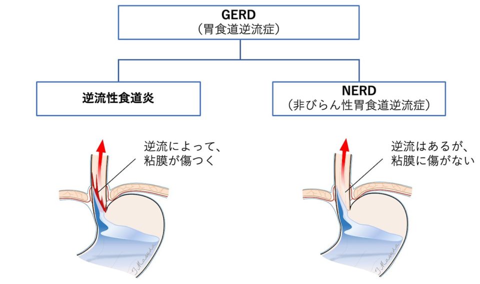 逆流性食道炎とNERD