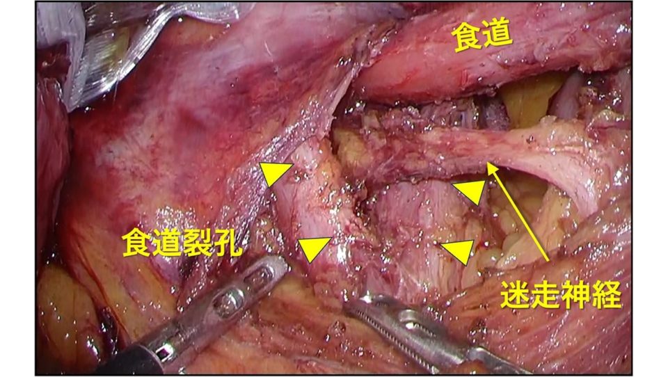 重症逆流性食道炎　症例